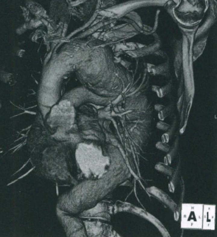 案例8:胸主動(dòng)脈瘤腔內(nèi)治療——復(fù)合技術(shù)與單分支移植物